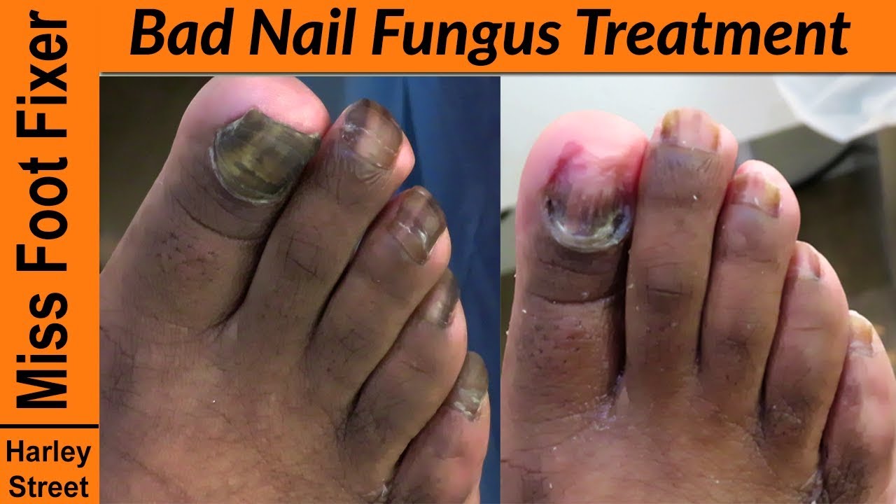 Toenail Fungus Removal by 980nm Diode Laser Machine